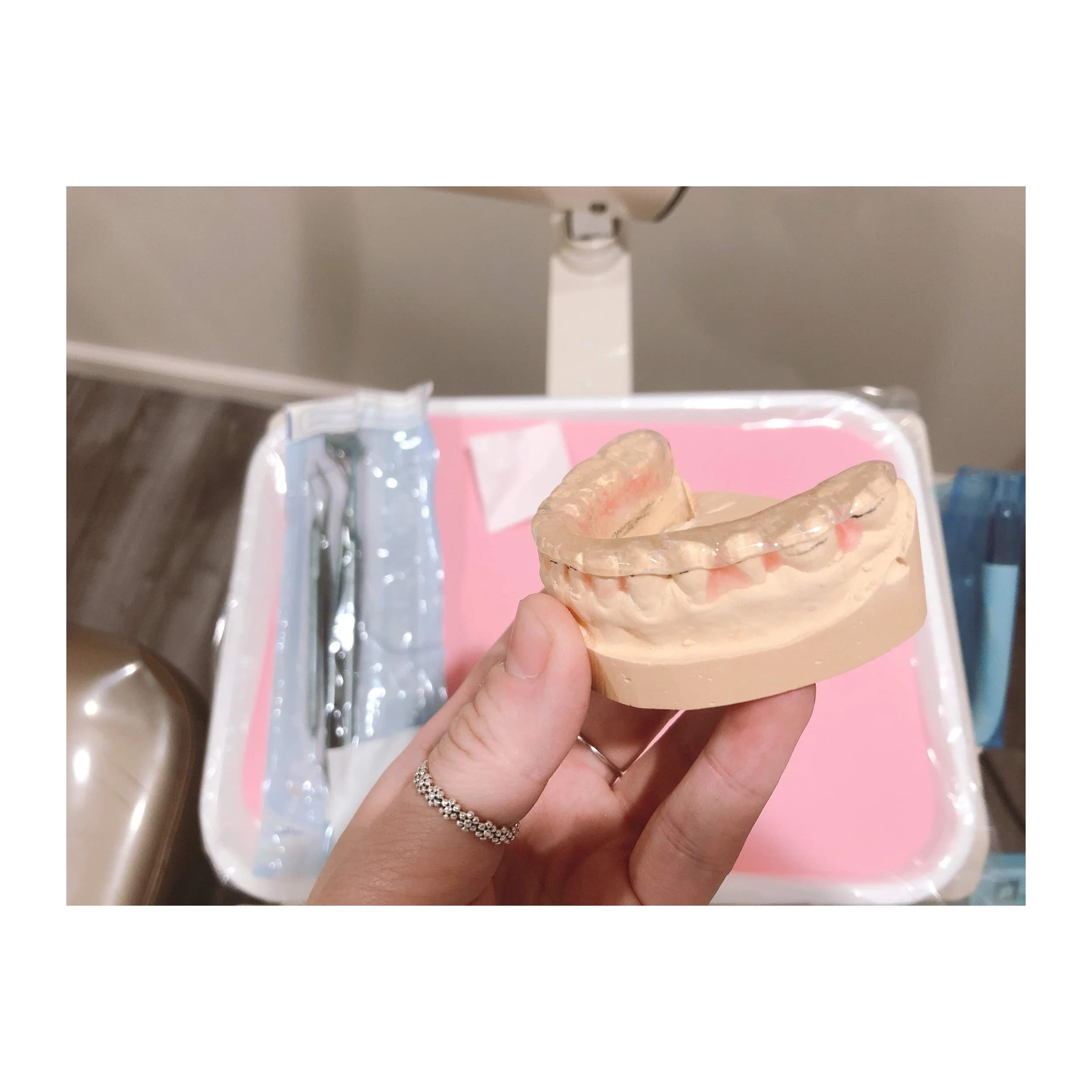 Dental model with a clear night guard, showing how teeth can be protected from clenching and grinding.
